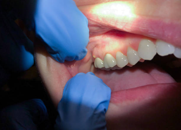 Best Emergency Dental Care for Sports Injuries in Menard, TX
